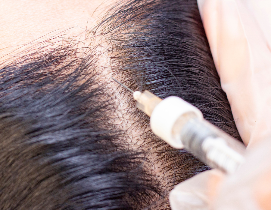 PRP Hair loss treatment