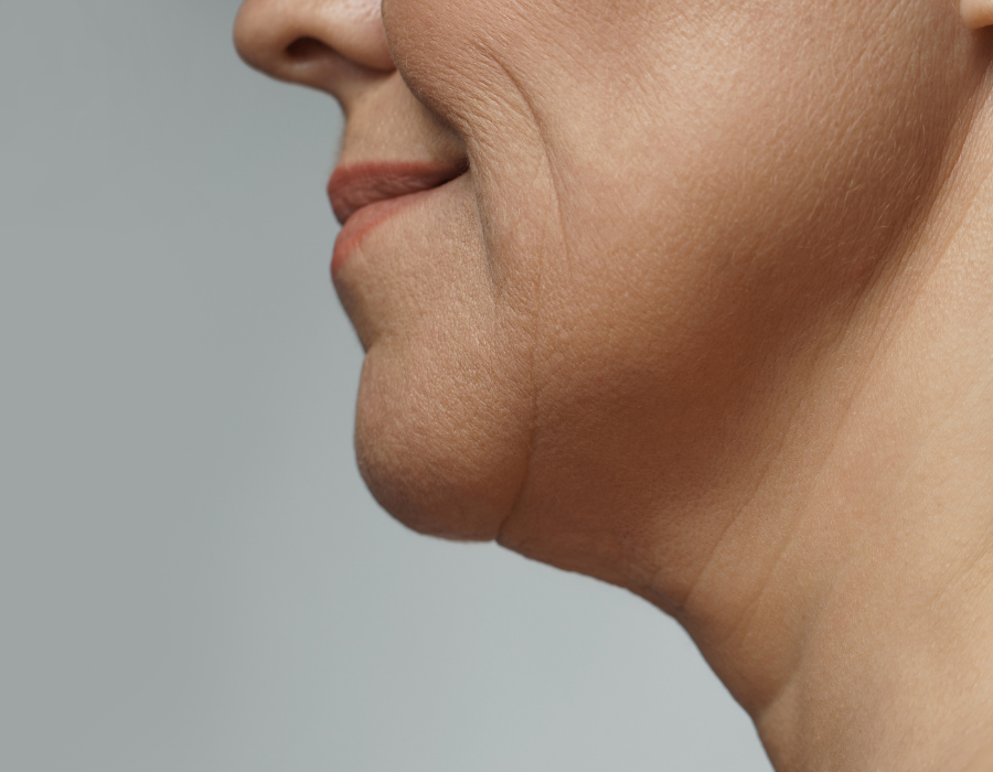 saggy neck